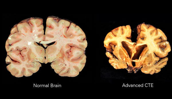 Comparación de un cerebro sano con otro con evidencia de CTE
